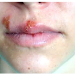 herpes_labial