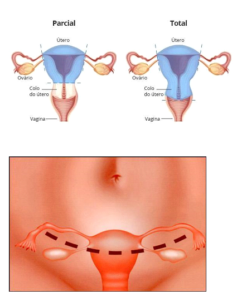 tipos de histerectomia