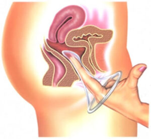 como usar a camisinha feminina