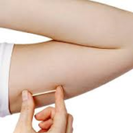 imagem de implante contraceptivo implanon