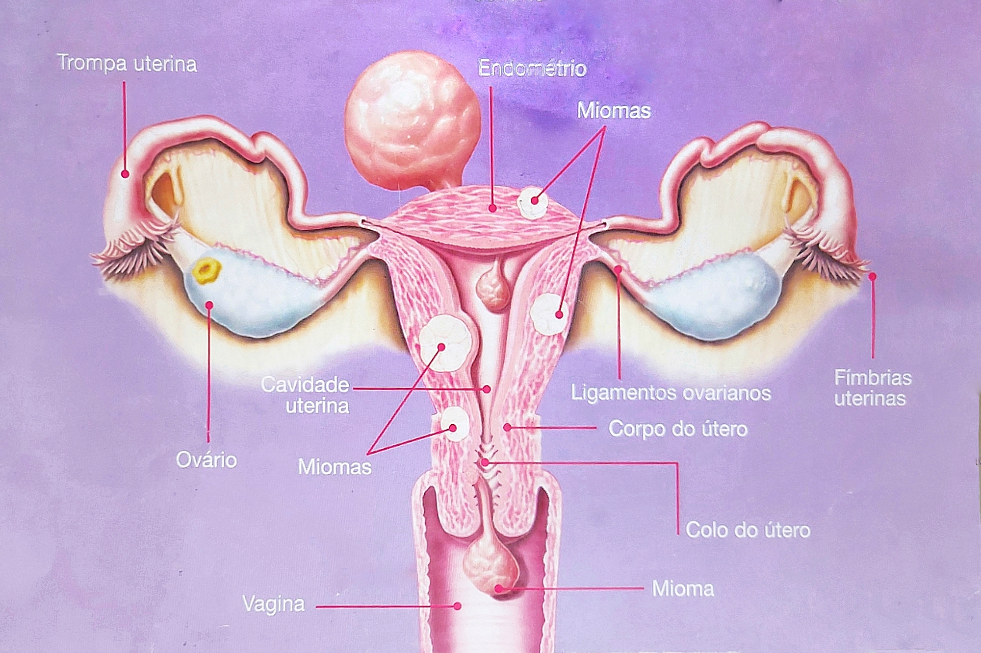 miomatose uterina ou miomas