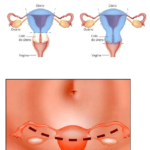 tipos de histerectomia