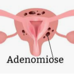 Adenomiose: o que é, sintomas e tratamento.